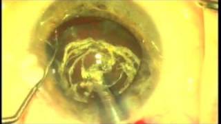 Nanotechnology in Cataract Surgery Fugo Plasma Blade Ablation Capsulotomy [upl. by George792]