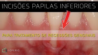 Ep 79 Incisão papila inferior [upl. by Cyprian330]