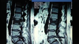 Spine Lecture Kyphoplasty [upl. by Ewnihc]