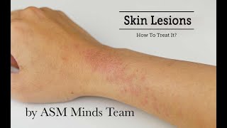 Skin lesions part 1Benign and Premalignant by ASM Minds Team [upl. by Mccowyn432]