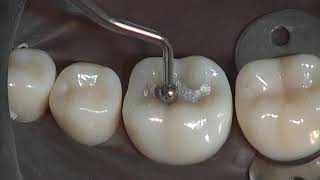 Class I Amalgam Preparation amp Restoration  Operative Dentistry [upl. by Farant588]