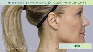 Age Spots  Seborrheic Keratosis New Treatment ESKATA  ESKATA for SKs [upl. by Zingg]