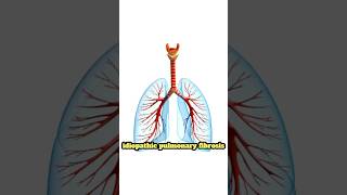 Treatment Strategies for Idiopathic Pulmonary Fibrosis IPF treatment pulmonaryfibrosis lungs [upl. by Oicul]