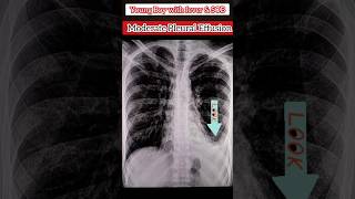 Pleural Effusion on XRay Chest 🩻 medical xray diagnosis radiology ultrasound shorts [upl. by Hebe]