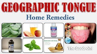 Home Remedies for Geographic Tongue [upl. by Emmie]