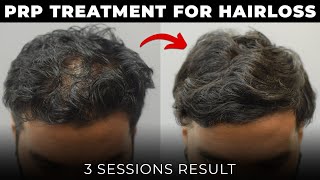 PRP Hair Loss Treatment Results  3 Sessions Result prptreatment [upl. by Celestia354]