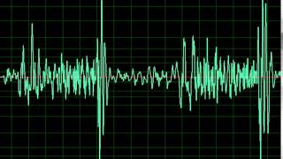 Mitral Regurgitation Tricuspid Regurgitation slow [upl. by Eanat]