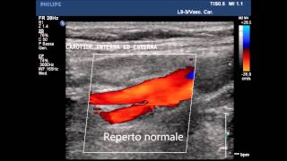 Corsi di ecocolordoppler dei TSA Tronchi Sovra Aortici [upl. by Merna]