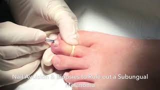 Nail Biopsy to Rule out melanoma under the nail [upl. by Nap840]