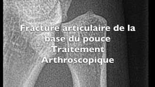 Chirurgie du pouce sous arthroscopie pour une fracture de Bennett Toulouse [upl. by Neehsar583]