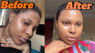 How I cleared my acne using 2 products My acne journey [upl. by Nelson]