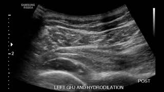 Shoulder Ultrasound Hydrodilation of Adhesive Capsulitis Part 1 [upl. by Kaitlynn]