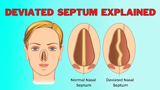 What Causes A Deviated Nasal Septum A Surprising Reason [upl. by Zerimar]