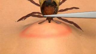 How To Remove A Tick [upl. by Alithea]