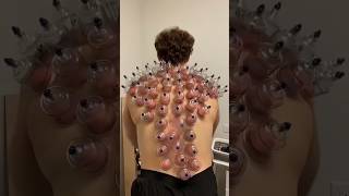 Cupping Tharapy Explained 😱🤯 shorts facts [upl. by Marola]