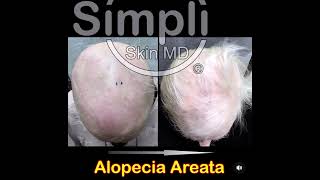 Alopecia Areata [upl. by Eelyme]