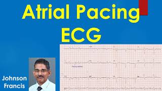 Atrial Pacing ECG [upl. by Oira218]