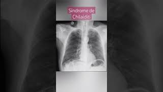 SINDROME DE CHILAIDITI SÍNTOMAS [upl. by Peregrine]