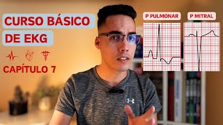 Crecimiento auricular electrocardiograma [upl. by Doownelg]