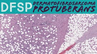 DFSP Dermatofibrosarcoma Protuberans 5Minute Pathology Pearls [upl. by Aihsoek]