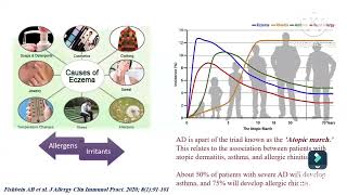 Atopic dermatitis diagnosis amp assessment Prof Ghada Shousha Pediatric immunology amp allergy Ain Shams [upl. by Arimlede]