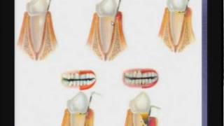 O que são doenças periodontais [upl. by Minda]