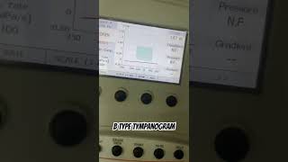 Tympanometry B type tympanogram audiology tympanicmembraneperforation [upl. by Payne]