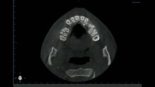 multiple impactions by Dr Mohamed Elshamaa [upl. by Gurevich]