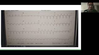 04 07 2024 Case Presentation Cirrhotic Patient for Right Hepatectomy [upl. by Sylvie]