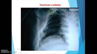 Neumologia Parte 2 Semiologia de Suros [upl. by Asim]