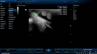 An encysted hydrocele  a noncommunicating type of inguinal hydrocoele ultrasound cases [upl. by Thomasin508]