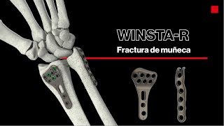 WINSTAR®  Fractura radio y cúbito distal [upl. by Nylazor]