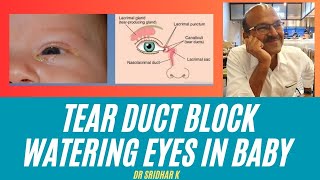 Tear duct block in babies l Nasolacrimal duct obstruction and watering eyes [upl. by Nainatrad]