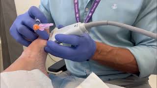 Sesamoid injection for osteoarthritis [upl. by Hillary]