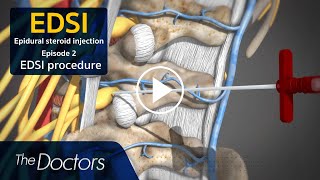 The Doctors Epidural Steroid Injection EDSI procedure [upl. by Miki]