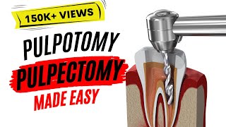 Pulpotomy and Pulpectomy  PEDIATRIC DENTISTRY [upl. by Ymeon]