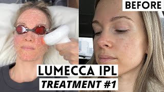 LUMECCA IPL  BEFORE amp AFTER  VLOG [upl. by Adiehsar607]