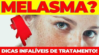 MELASMA TEMPO de Tratamento e Dicas Para Acelerar o Processo [upl. by Malin815]