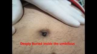 Clean Your Navel Belly Umbilicus Properly Or You may Face this In Your Belly Button [upl. by Marguerite944]