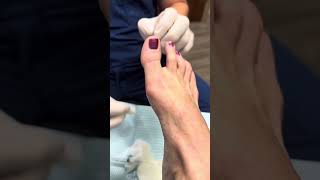 Aspiration of a cyst in the foot [upl. by Nnaira]