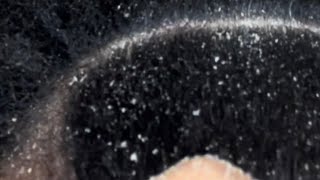 Dandruff Scratching Dry Crunchy Scaly Seborrheic Dermatitis Flakes Off Itchy Scalp [upl. by Etiuqram]