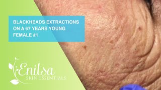 Blackheads Extractions on a 67 Years Young Female [upl. by Eal954]