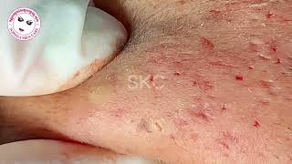 Acne facial removal treatment by Sopheaskincare 29th October 2023 [upl. by Accber442]