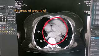 Nodules of Chest Part 02  Chest CT pathology  Thyroid Nodules  Chest CT with Contrast  Dr Green [upl. by Glarum16]