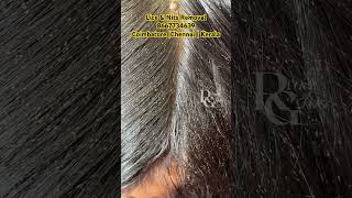 How to treat lice on hairhow to remove lice from hairlice removallice nits treatment in parlour [upl. by Allecram]