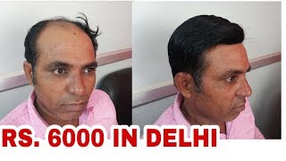 9990115900 hair weaving Rs 5500 Hair weaving cost Hair weaving price in delhi [upl. by Cecelia]