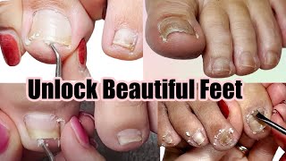 Pedicure Tutorial on Deep Compacted Ingrown Toenail [upl. by Charin827]