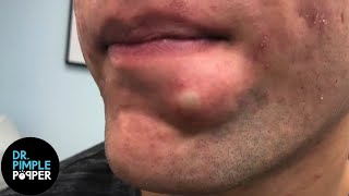 SATISFYING Dr Lee Pops Inflamed Cyst on Chin  Dr Pimple Popper Reacts [upl. by Debby]