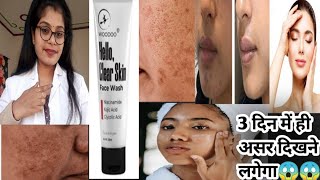 Woodoo Hello Clear Skin Face Wash Honest ReviewHello clear skin face wash usesampside effects review [upl. by Nydnarb]