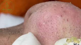 Loan Nguyen Acne Treatment 00037 [upl. by Sainana]